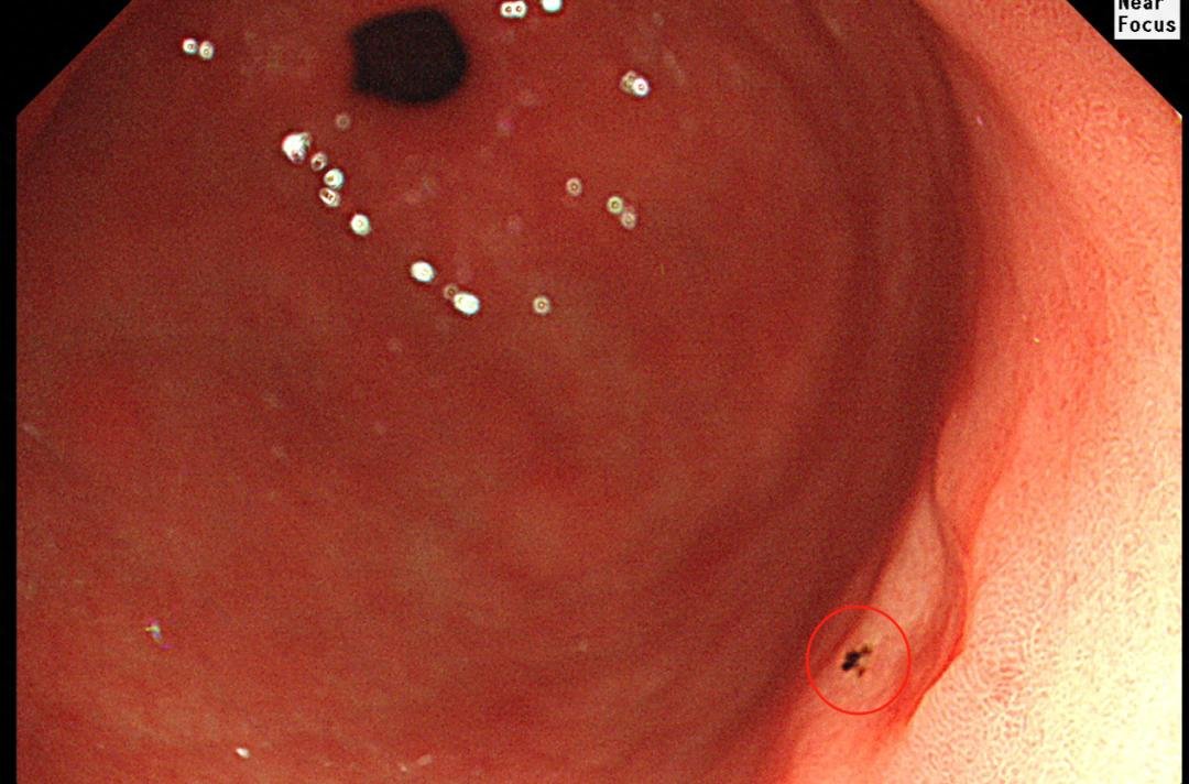 一个小小的胃溃疡，确诊“癌王”！多数发现即晚期