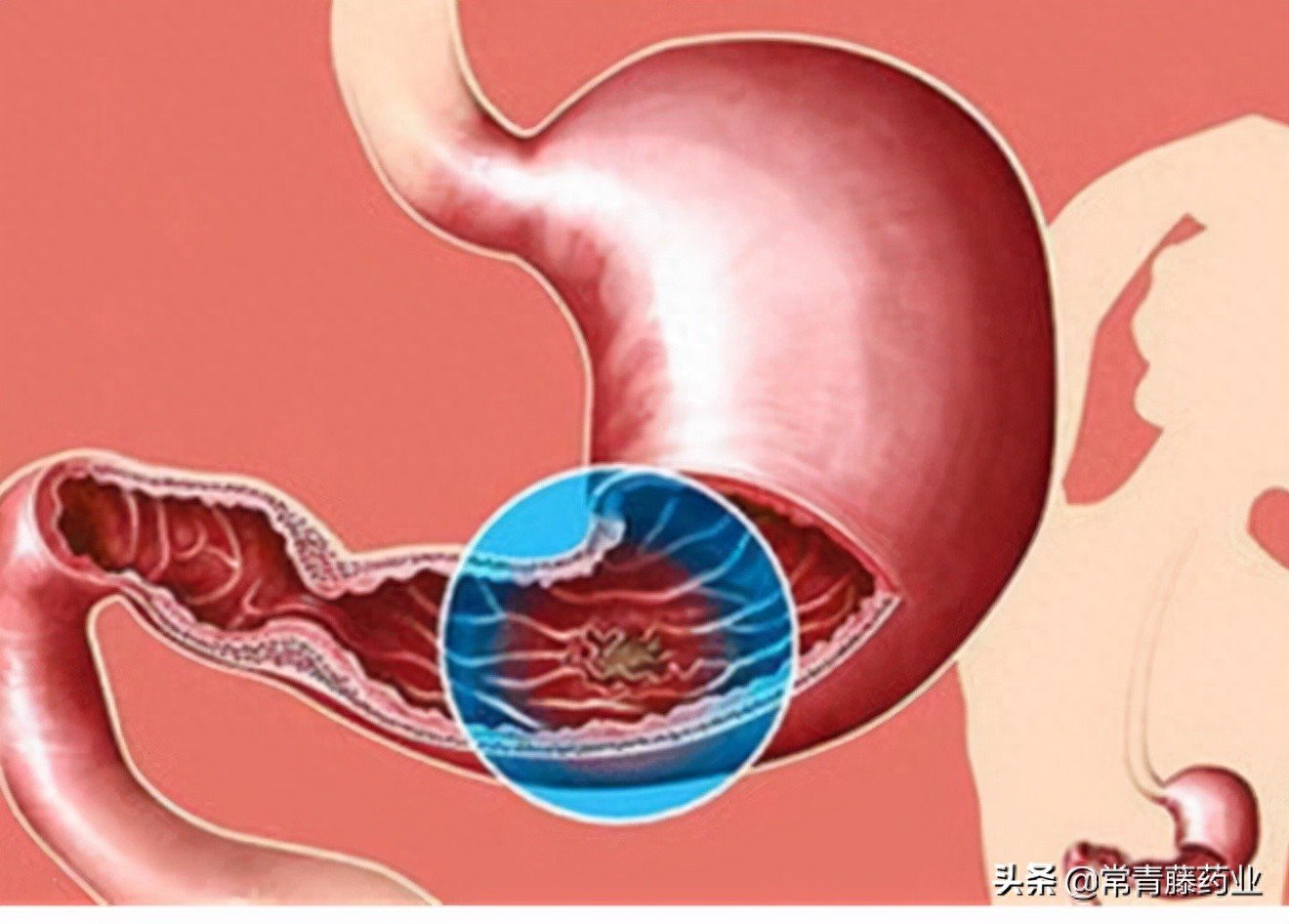 10个人当中就有1个患者！胃部经常一阵阵绞痛，胃溃疡如何治疗？